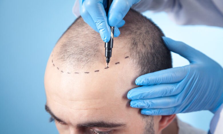 Hair loss consultation with a doctor marking the scalp