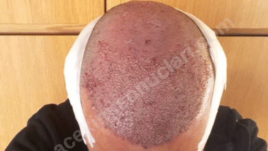 Dr. Serkan Aygin 3500 graft hair transplant result 6